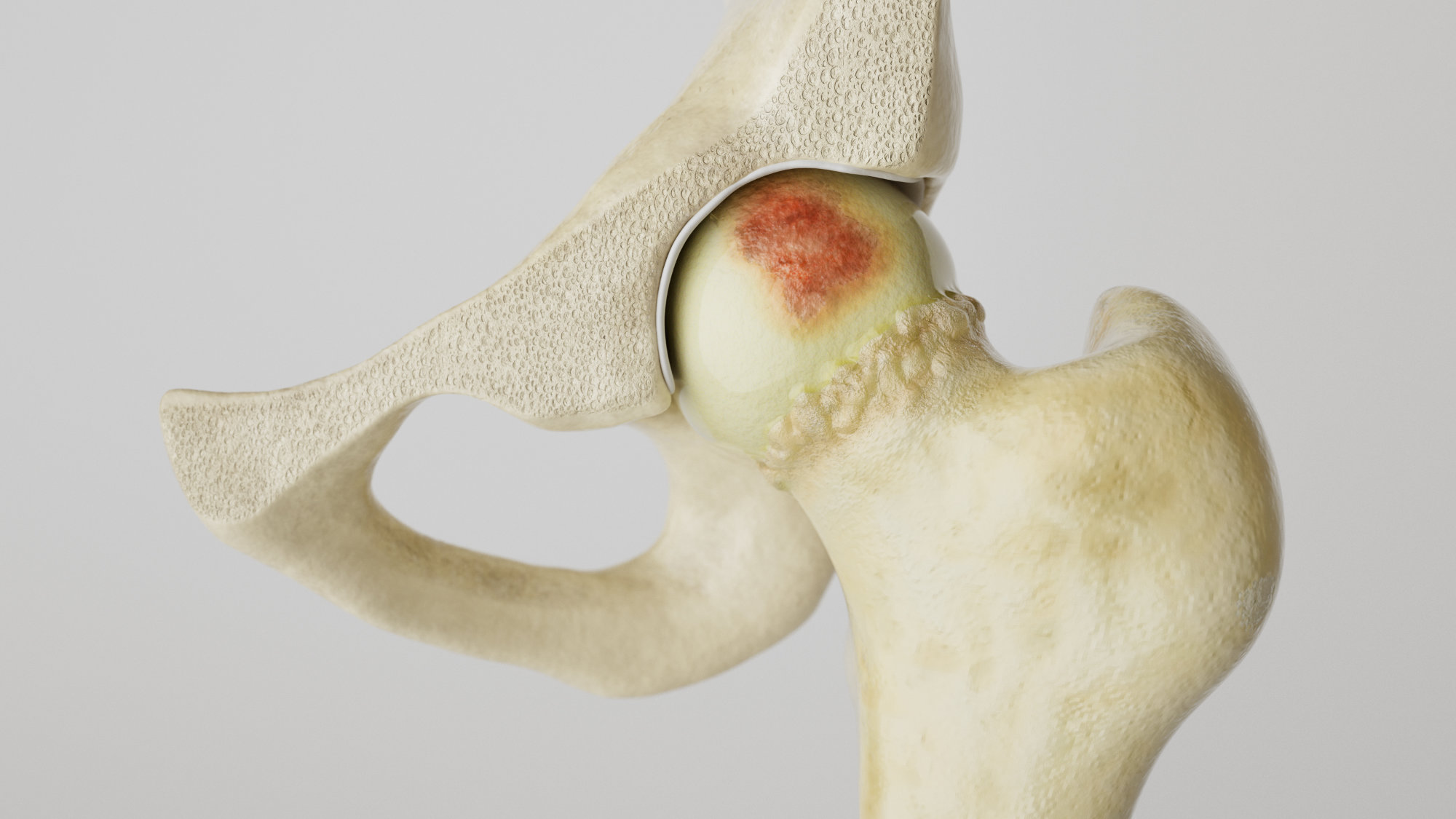 Hüftgelenk mit Arthrose