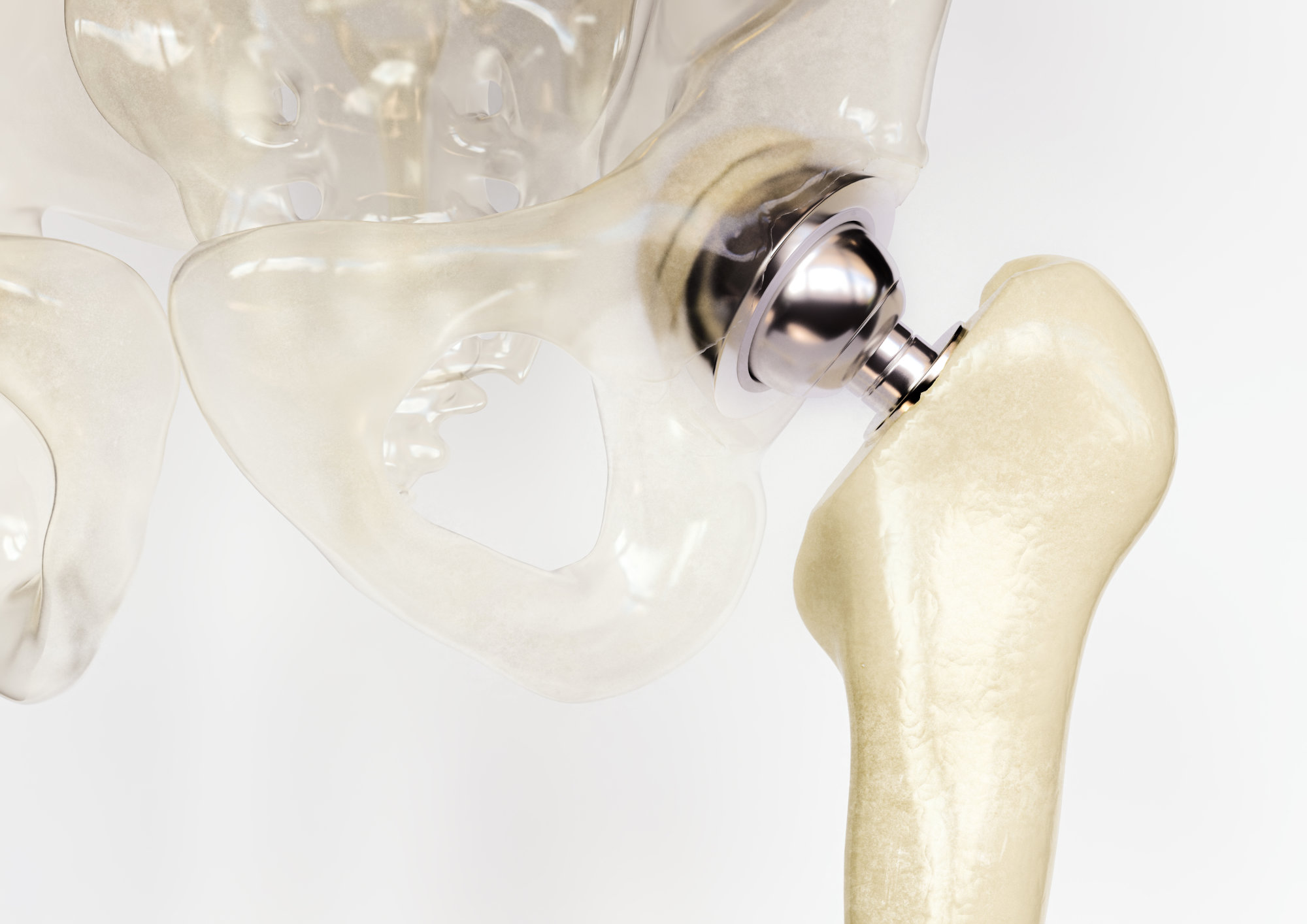 Künstliches Hüftgelenk — Implantat-Visualisierung