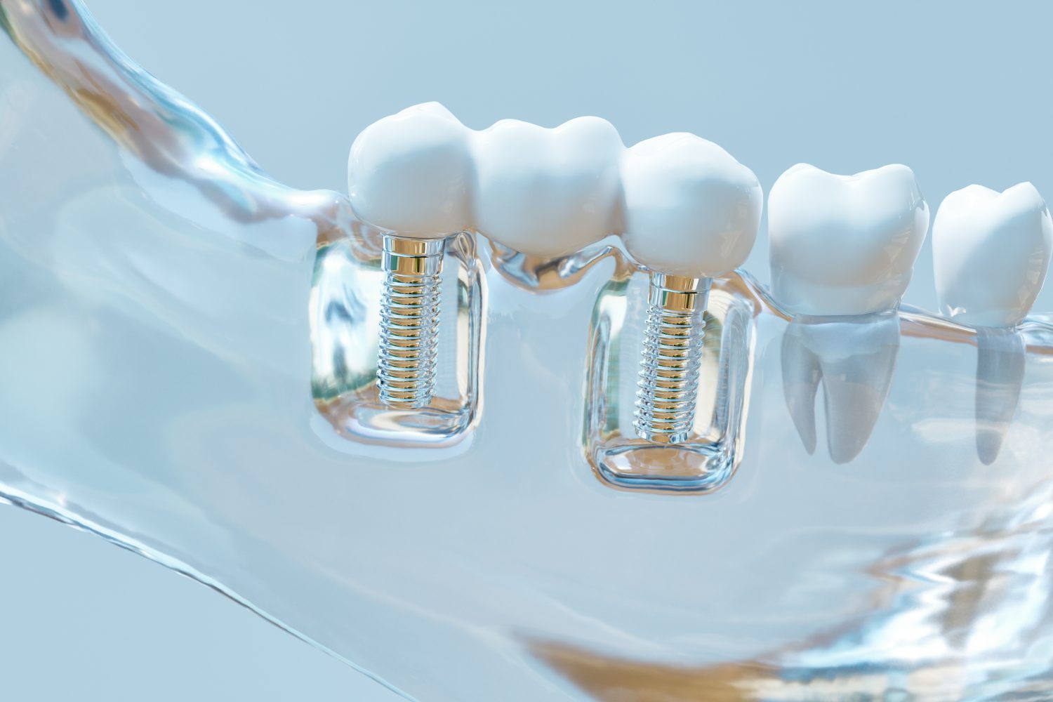 Implantatgetragene Brücke im transparenten Kiefer