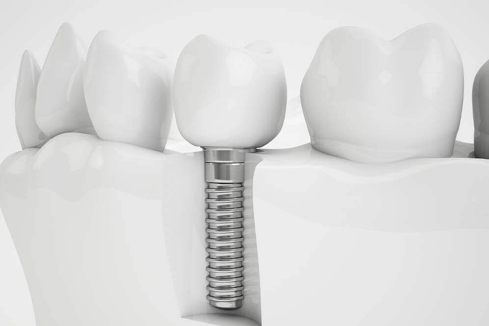 Einzelzahn-Implantat im Zahnbogen