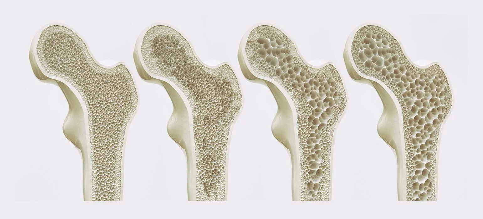 Osteoporose — Knochenstruktur am Femurkopf