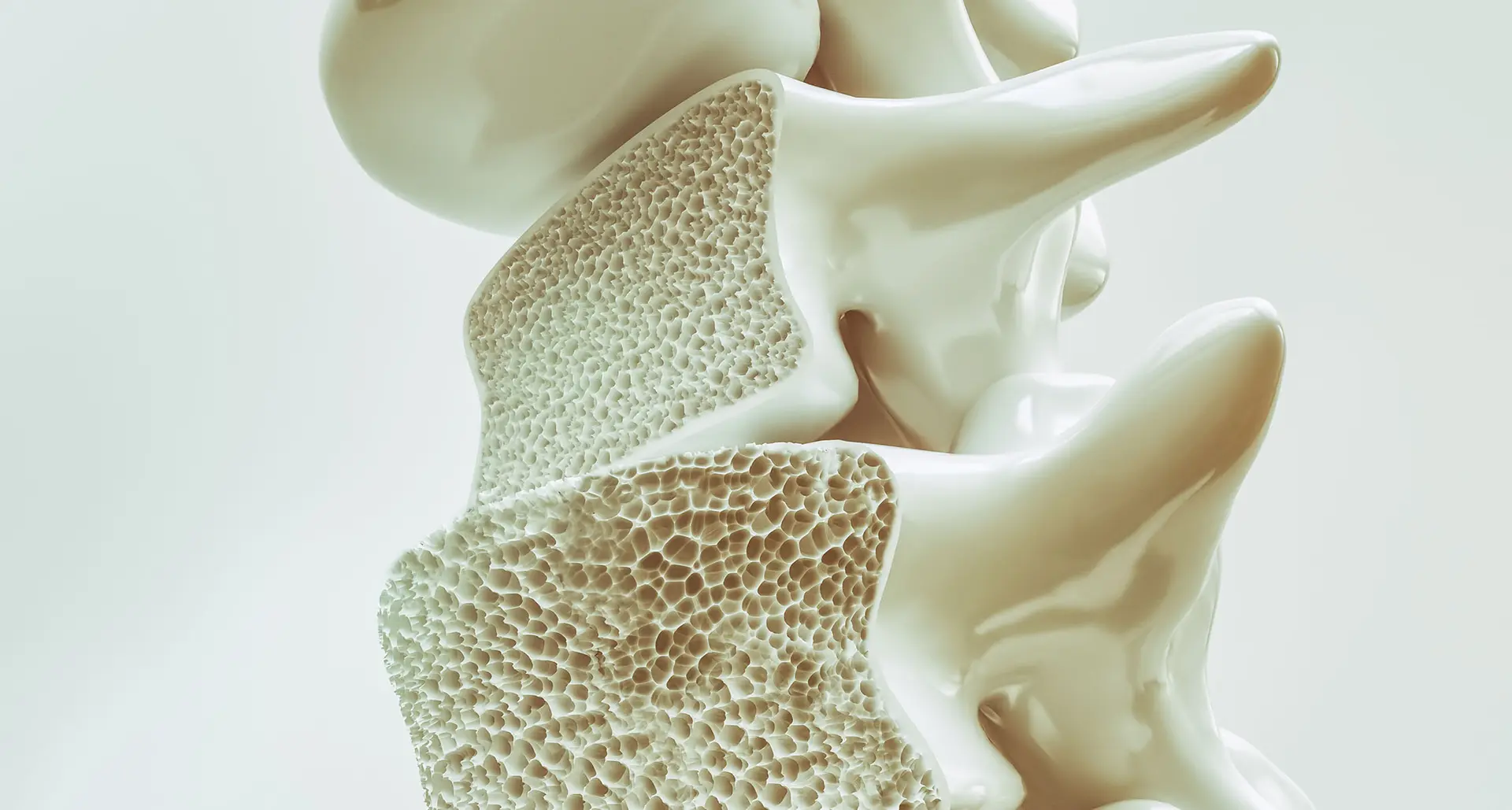 Osteoporose — Wirbelkörper im Anschnitt